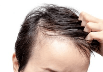 Haardichte und Haartransplantation