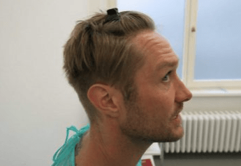Nico Schwanz Haartransplantation bei MyHair Medical