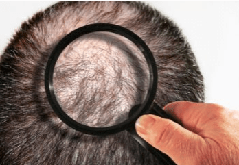 Androgenetische Alopezie/ Genetisch bedingter Haarausfall