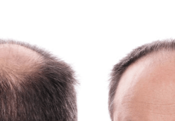 Arten von Haarausfall